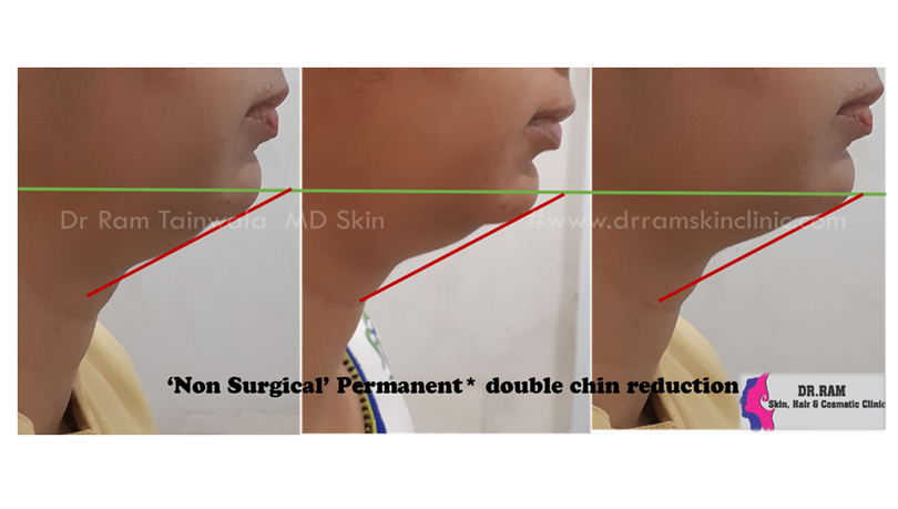Double chin reduction
