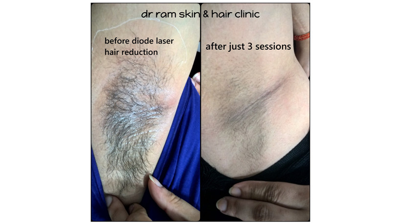Diode laser hair reduction