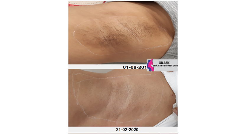 Diode laser hair reduction