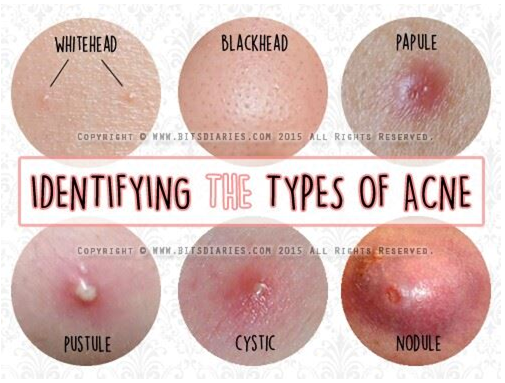 Acne-Pimples