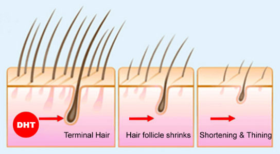 Hair Thinning/Balding For Men