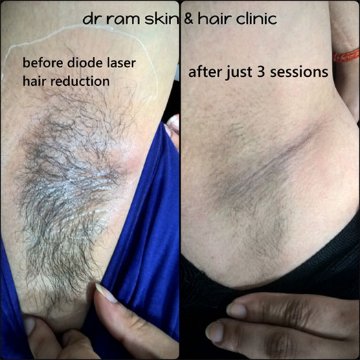 Laser Hair Removal Cosmetic Laser Treatment Botox Hair Treatment