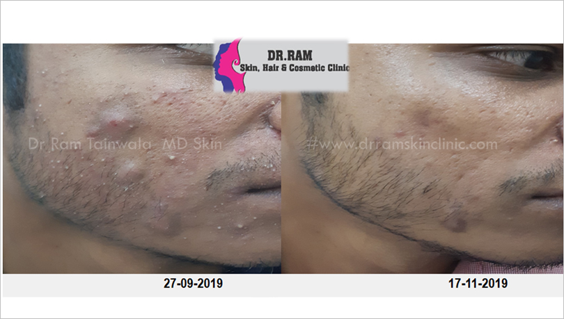 Acne Management treatment result