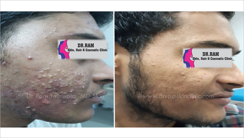 Acne Management treatment result