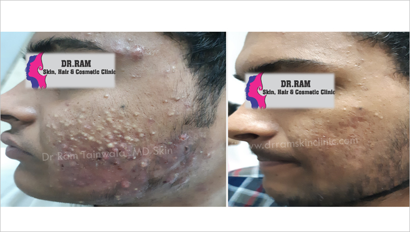 Acne Management before and after result