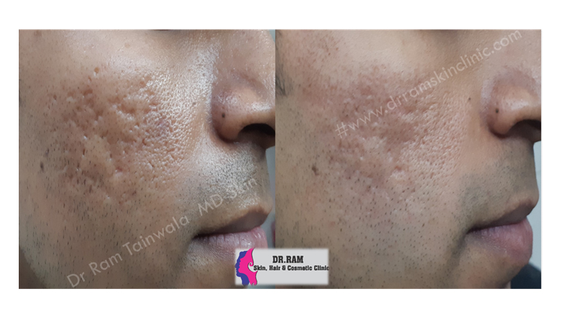 Acne Scars treatment result