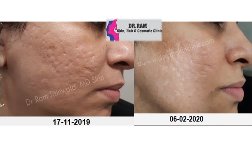 Acne Scars treatment result