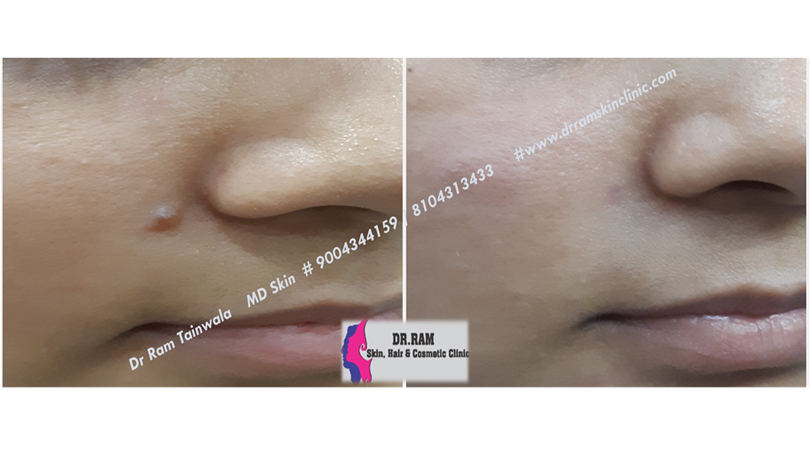 Acne Scars treatment result