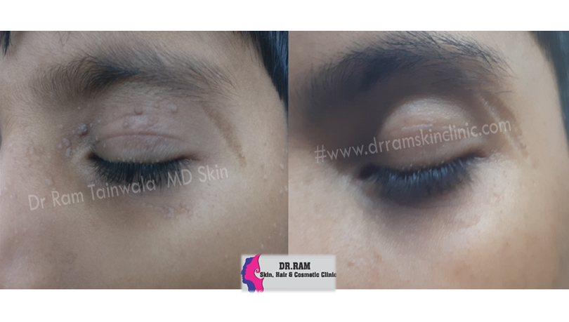 Acne Scars treatment result