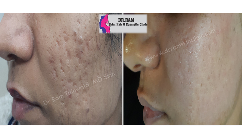 Acne Scars treatment result