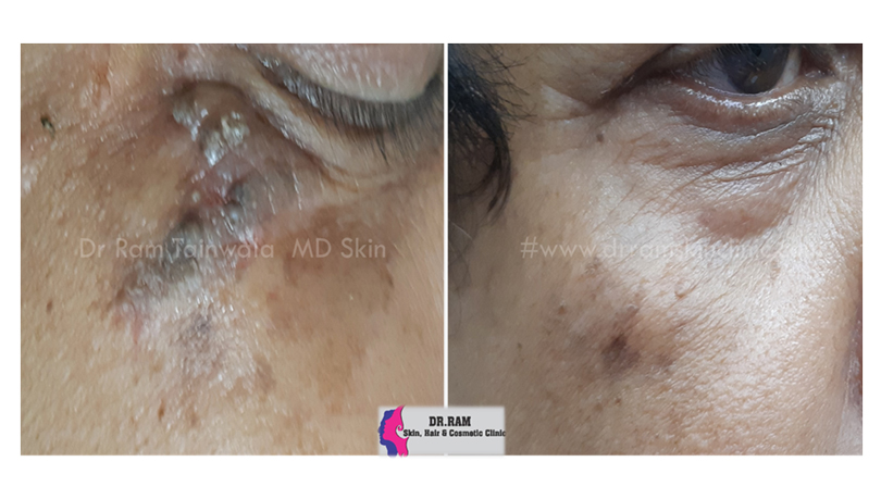 Bacterial Skin Infections treatment result