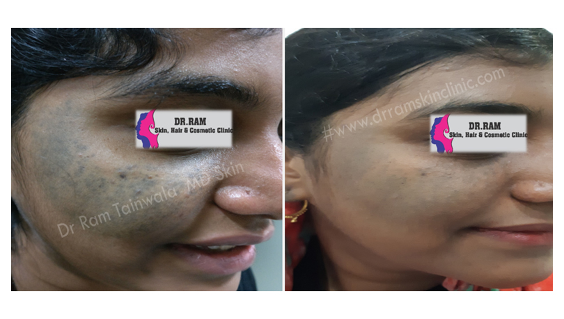 Birth Marks treatment result