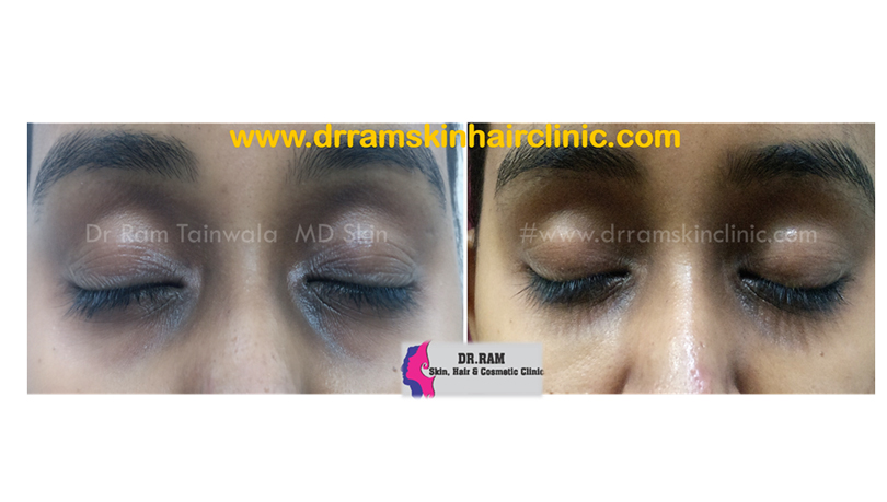 Dark Circles treatment result