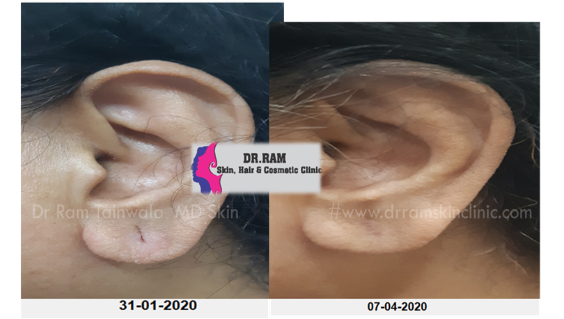 Ear Lobe Repair treatment result