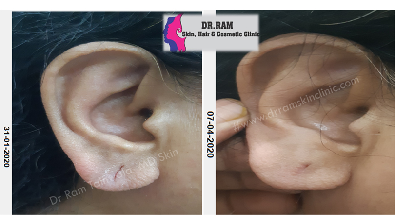 Ear Lobe Repair treatment result