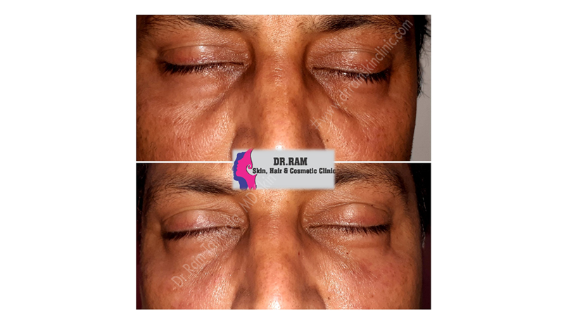 Fillers For Tired Eyes treatment result