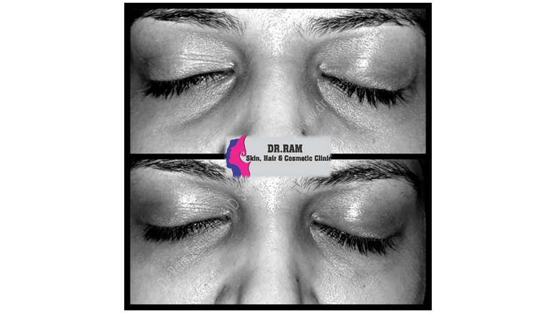 Fillers For Tired Eyes treatment result
