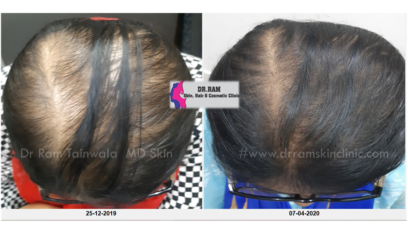 Female Balding treatment result