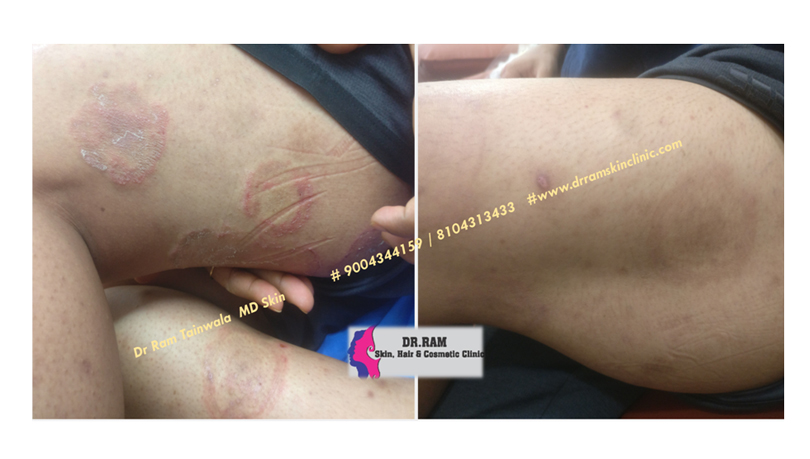 Fungal Infection treatment result