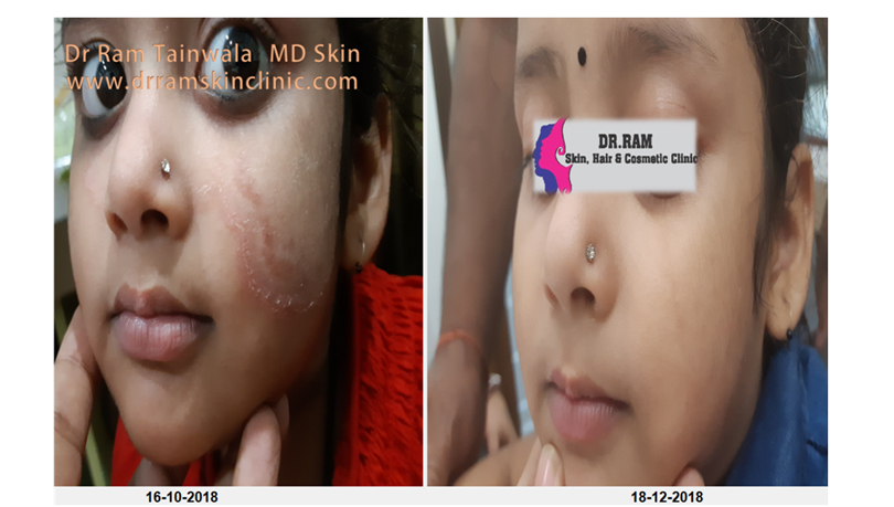 Fungal Infection treatment result