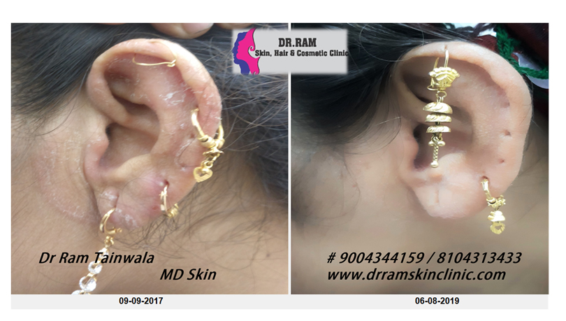 Fungal Infection treatment result