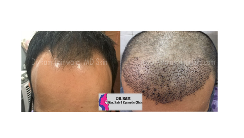 Hair Transplant treatment result