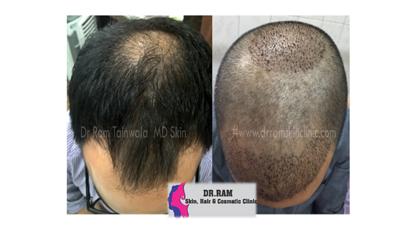 Hair Transplant treatment result