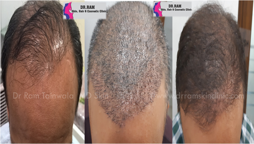 Hair Transplant treatment result