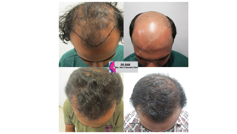 Hair Transplant before and after result