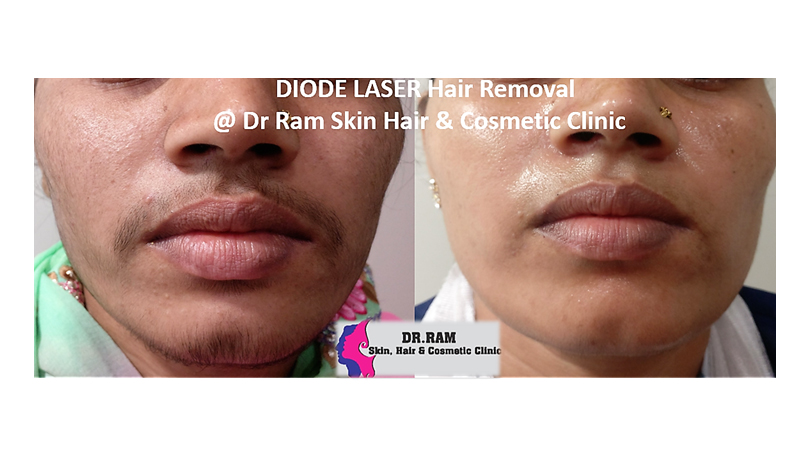 Laser Hair Reduction treatment result