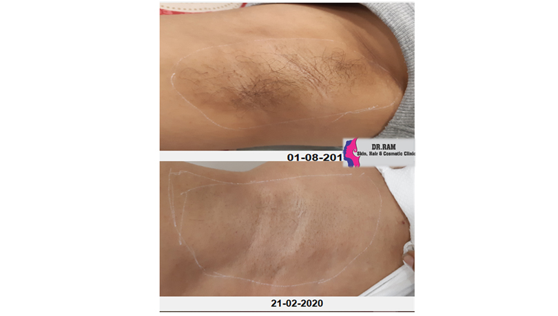 Laser Hair Reduction treatment result