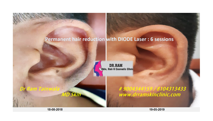 Laser Hair Reduction treatment result