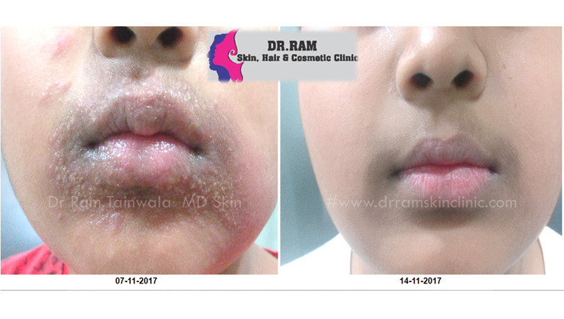 Lips treatment result