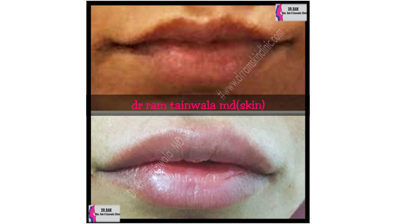 Lips treatment result