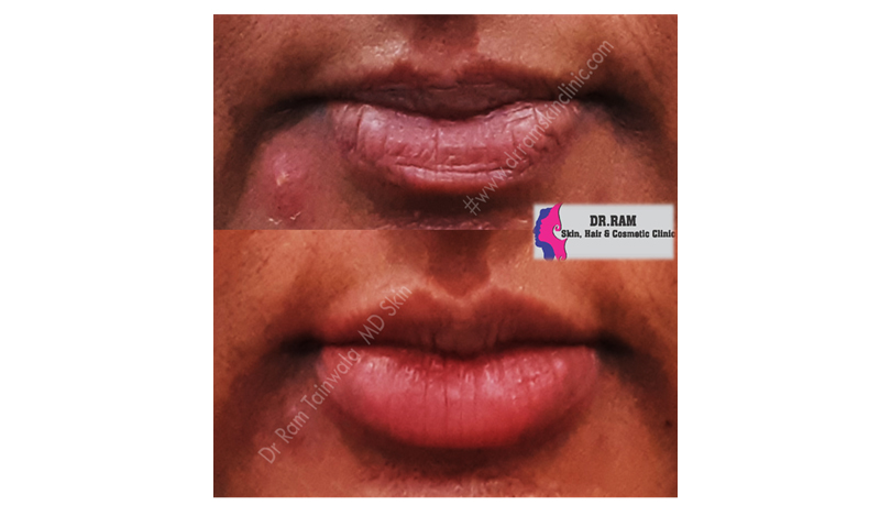Lips treatment result