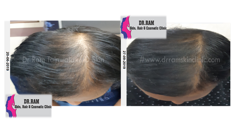 Male Balding treatment result