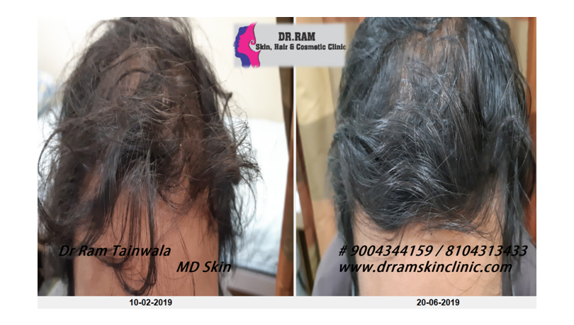 Male Balding treatment result