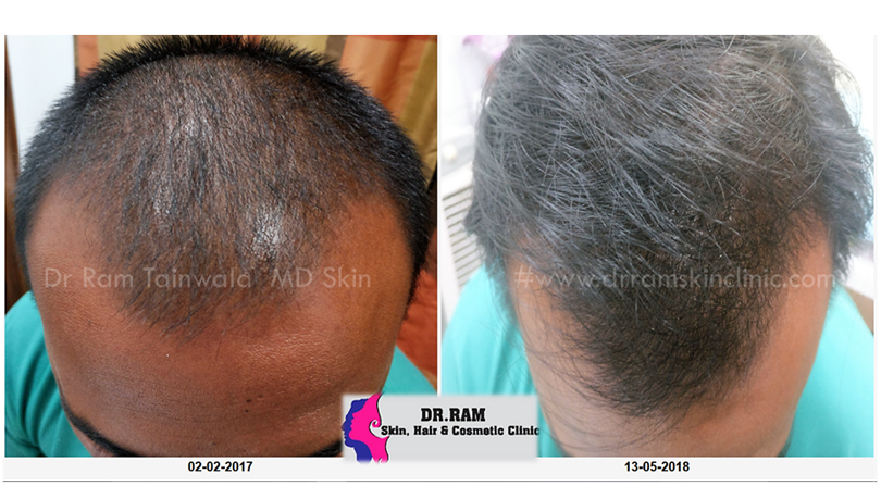 Male Balding treatment result