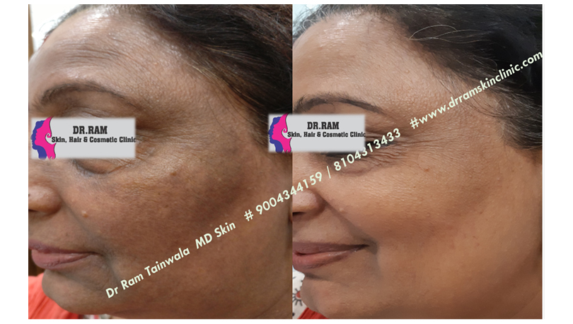 Pigmentation treatment result