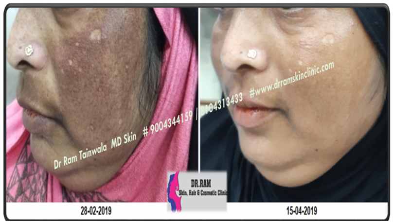 Pigmentation before and after result