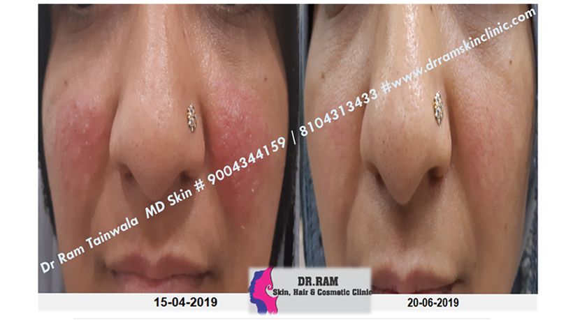 Wart Removal & Growths treatment result