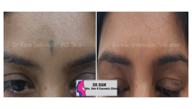 Tattoo Removal treatment result