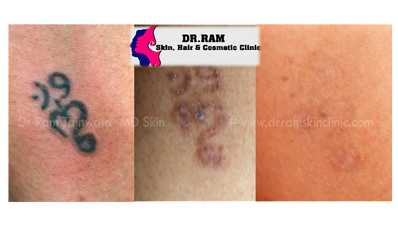 Tattoo Removal treatment result