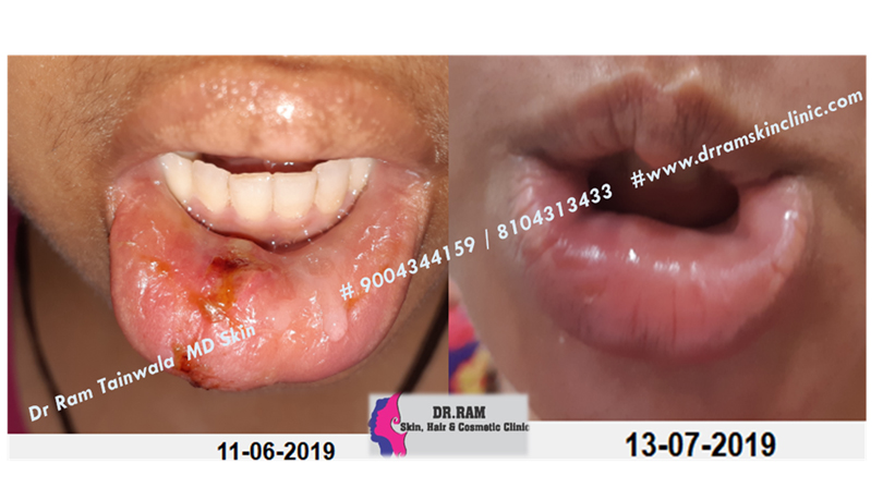 Trauma treatment result