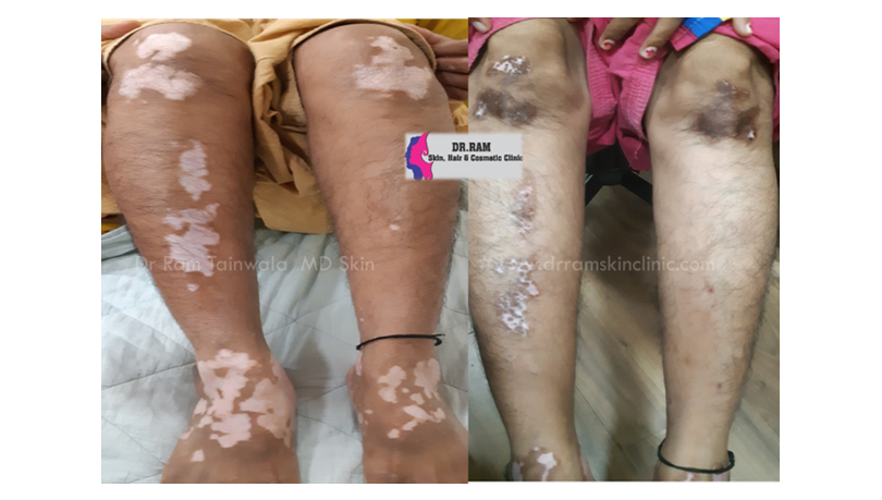 Vitiligo treatment result
