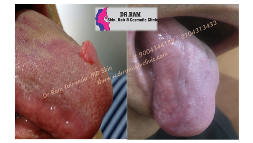 Wart Removal & Growths treatment result