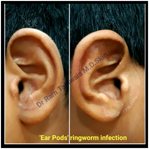 Ear Pods Users: Watch Out