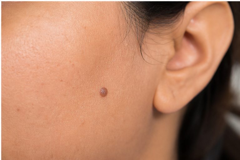 Melanocytic Moles (Nevi)