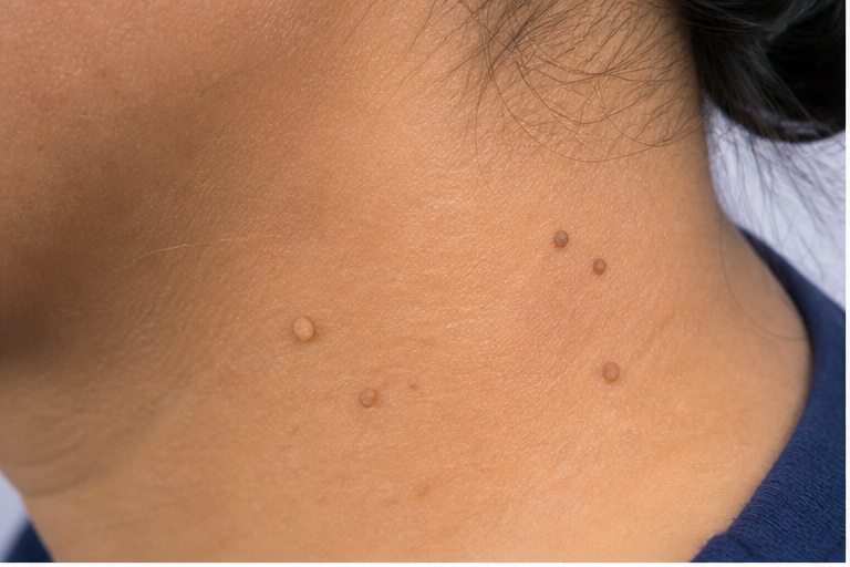 Skin Tags (Acrochordons)