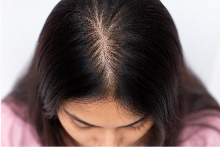 Chronic Telogen Effluvium